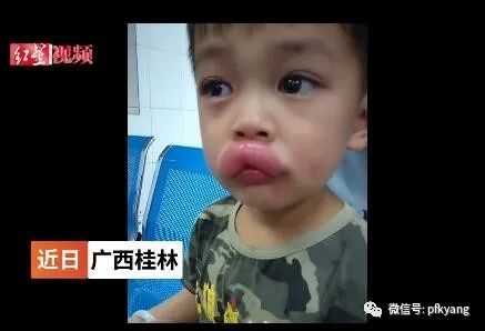 男孩吃葡萄過敏腫成嘟嘟嘴怎么回事？畫面詳情曝光網(wǎng)友忍不住笑了(圖5)